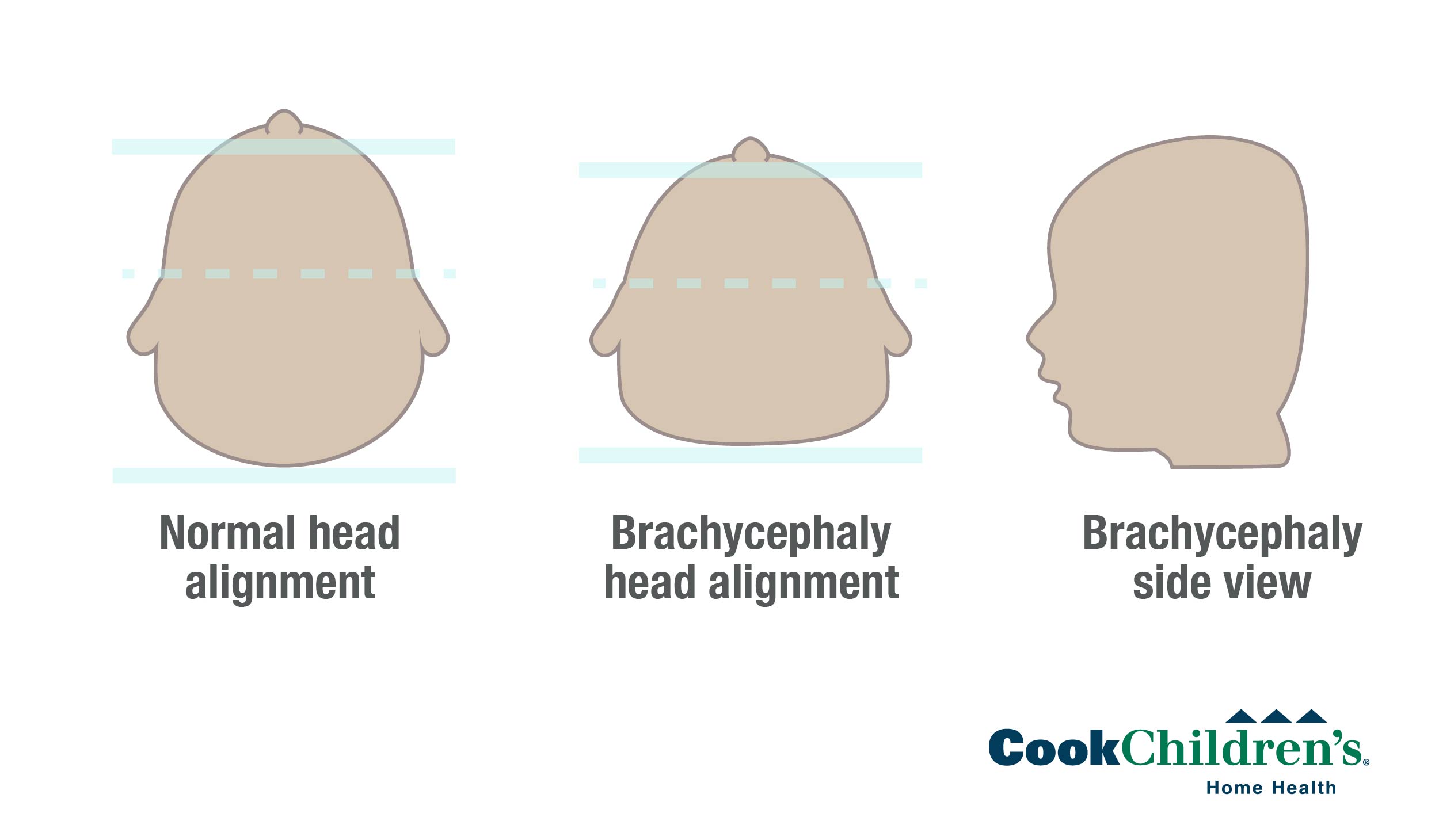 brachycephaly-positional