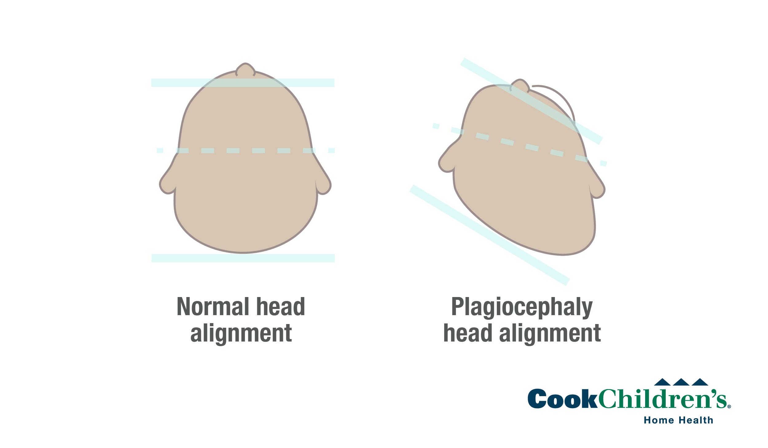 plagiocephaly-positional