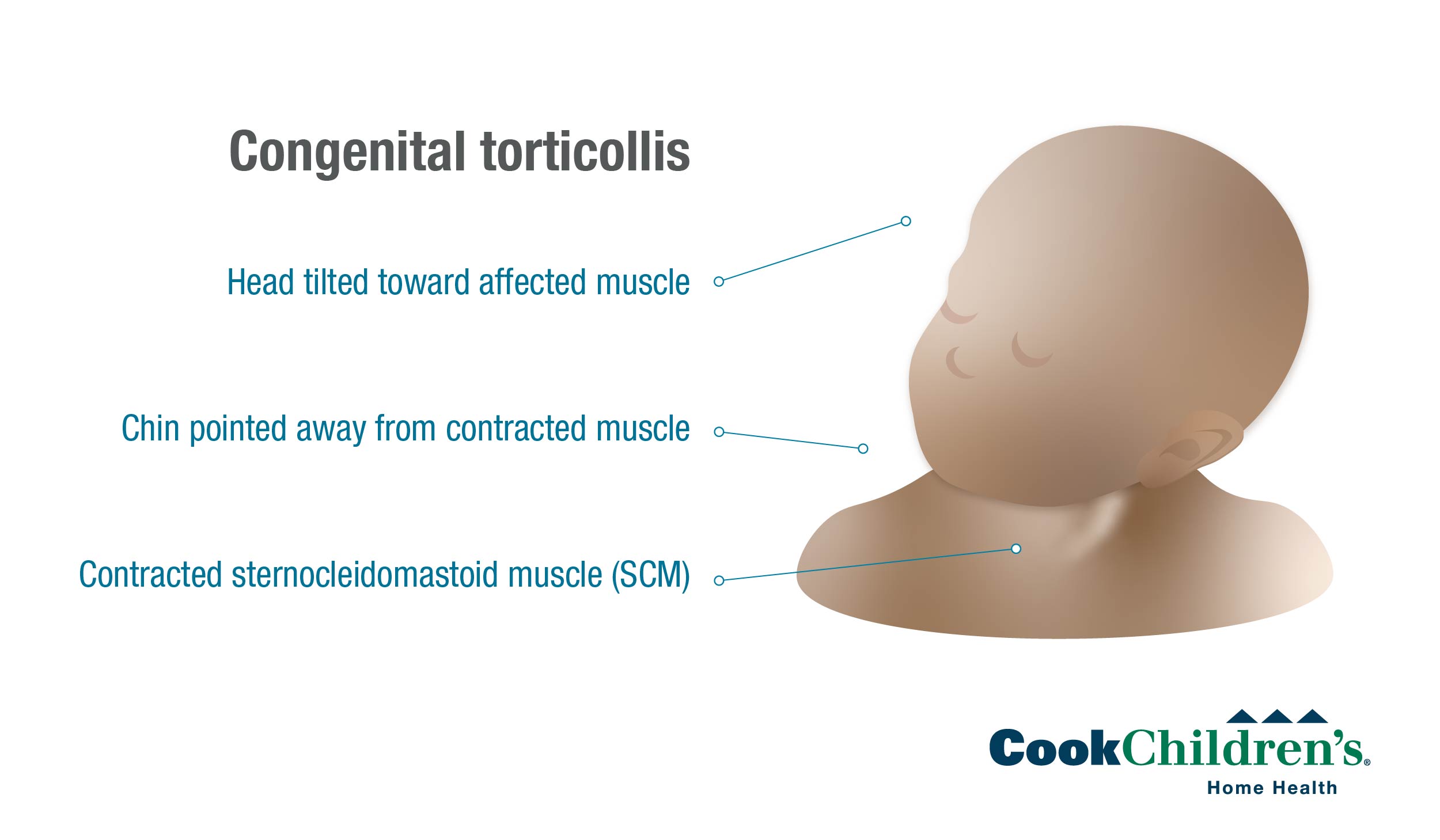 torticollis-congenital